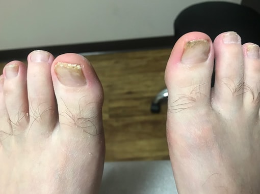 Toenail Fungus